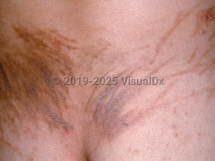 Clinical image of Drug-induced flagellate pigmentation - imageId=598666. Click to open in gallery.  caption: 'A close-up of flagellate brown plaques on the lower back, some scaly, following medication infusion.'