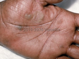 Clinical image of Epidermolysis bullosa simplex - imageId=605236. Click to open in gallery.  caption: 'Scaling and flaccid bullae on the palm.'