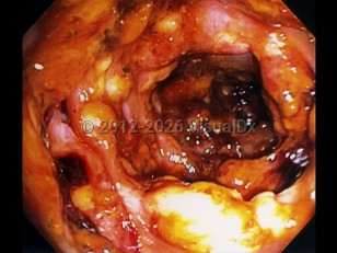 Imaging Studies image of Clostridioides difficile colitis - imageId=6107140. Click to open in gallery. 