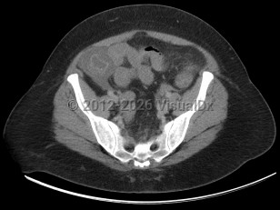 Neutropenic enterocolitis
