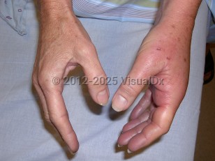 Clinical image of Animal bite infection - imageId=6112227. Click to open in gallery.  caption: '<span>Pasteurella multocida infection;</span> 24 hours post cat bite.<br />'