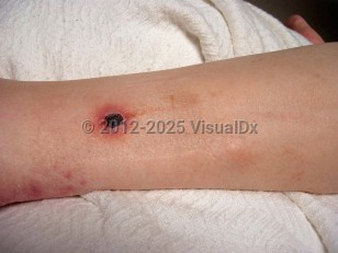 Clinical image of Paecilomyces lilacinus infection - imageId=6113352. Click to open in gallery.  caption: 'An erythematous plaque with a central eschar and a cluster of pink papules on the leg.'