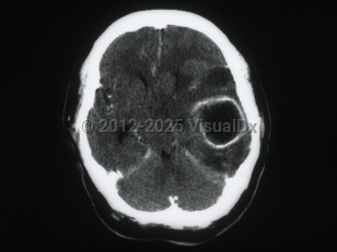 Imaging Studies image of Brain abscess - imageId=6161408. Click to open in gallery. 