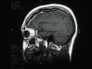 Imaging Studies image of Subdural empyema - imageId=6183132. Click to open in gallery. 