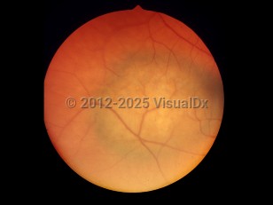 Ophthalmic Imaging image of Choroidal melanoma - imageId=6207061. Click to open in gallery. 