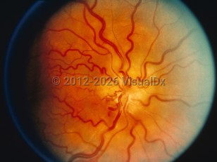 Papilledema