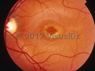 Ophthalmic Imaging image of Stargardt disease - imageId=6214948. Click to open in gallery. 