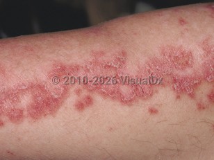 Subacute cutaneous lupus erythematosus