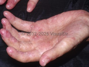 Clinical image of Chronic graft-versus-host disease - imageId=6320846. Click to open in gallery.  caption: 'Sclerodactyly with some pink, scaly, and eroded plaques on the fingertips. Note the thinned thumbnail and scattered hyperkeratotic papules on the palm.'