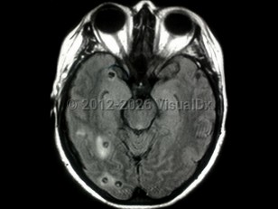 Neurocysticercosis