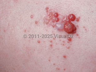 Clinical image of Hemangiopericytoma - imageId=642368. Click to open in gallery.  caption: 'A close-up of a cluster of smooth and glistening red papules of varying sizes.'