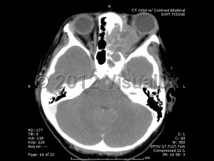 Imaging Studies image of Orbital rhabdomyosarcoma - imageId=6580891. Click to open in gallery. 