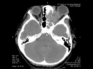 Imaging Studies image of Orbital rhabdomyosarcoma - imageId=6580891. Click to open in gallery. 
