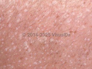 Clinical image of Stucco keratosis - imageId=659194. Click to open in gallery.  caption: 'A close-up of numerous tiny whitish, scaly papules with a stuck-on appearance.'