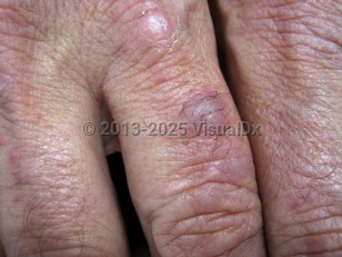 Clinical image of Microvenular hemangioma - imageId=6598976. Click to open in gallery.  caption: 'A violaceous and a pink scaly papule on the finger.'