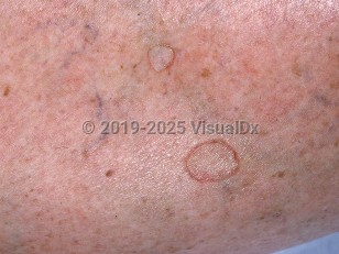 Disseminated superficial actinic porokeratosis