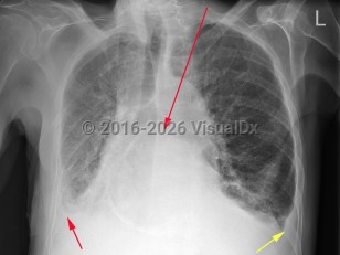 Imaging Studies image of Congestive heart failure - imageId=6789440. Click to open in gallery.  caption: 'PA chest xray demonstrating interstitial pulmonary edema with linear opacities throughout both lungs, peribronchial cuffing, and bilateral small pleural effusions, right, (small red arrow), and left, (small yellow arrow). In addition, there is a large hiatal hernia, (long red arrow).'