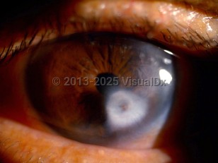 Ophthalmic Imaging image of Peters anomaly - imageId=6790350. Click to open in gallery.  caption: 'A paracentral corneal scar (leukoma).'