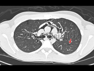 Imaging Studies image of Pneumomediastinum - imageId=6835520. Click to open in gallery.  caption: '<span>18 yo male with gradual onset chest pain. No clear precipitating event or trauma. Axial CT image of the chest demonstrates extensive mediastinal air outlining the heart, great vessels (straight white arrow), central bronchi (curved black arrow), and tracking into the neck. Interstitial emphysema is also seen (straight red arrow).</span>'