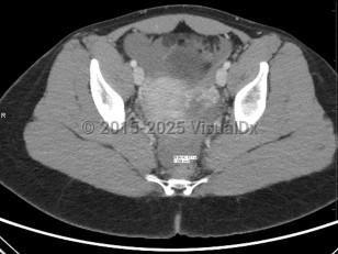 Imaging Studies image of Ectopic pregnancy - imageId=6844496. Click to open in gallery.  caption: '<span>Axial CT image demonstrates high  attenuation fluid in the pelvis consistent with blood. Patient with  subsequent positive pregnancy test, and found to have ruptured ectopic  pregnancy. </span>'
