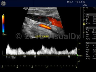 Imaging Studies image of Internal jugular vein thrombosis - imageId=6844807. Click to open in gallery.  caption: '<span>Grayscale image demonstrates a large thrombus within the internal jugular vein.</span>'