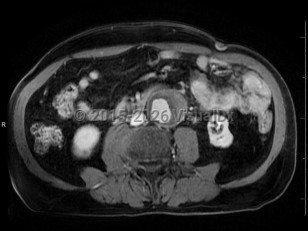 Abdominal aortic aneurysm