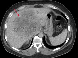 Imaging Studies image of Acinar cell carcinoma - imageId=6846684. Click to open in gallery.  caption: '<span>Axial post-contrast MRI  demonstrates two arterially enhancing lesions in the left hepatic lobe, which demonstrated washout in the portal venous phase (not shown).  Findings were consistent with hepatocellular carcinoma. </span>'