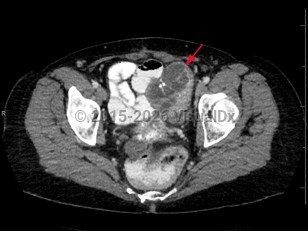 Ovarian cancer