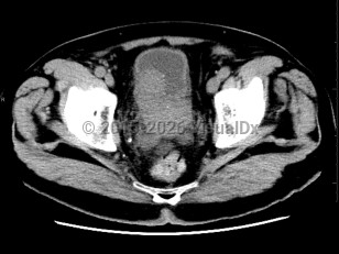Imaging Studies image of Prostate cancer - imageId=6847001. Click to open in gallery.  caption: '<span>Axial CT image demonstrates an  enlarged, bulky prostate gland which indents the bladder wall. Biopsy  was consistent with prostate carcinoma. </span>'