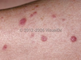 Leukemia cutis