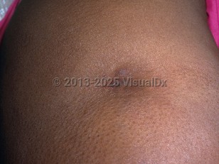 Clinical image of Lupus panniculitis - imageId=6964223. Click to open in gallery.  caption: 'A depressed, erythematous plaque with central scale on the arm.'