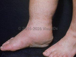 Congenital lymphedema