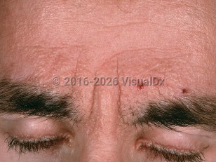 Clinical image of Lipoid proteinosis - imageId=706559. Click to open in gallery.  caption: 'Smooth, shiny, coalescing, yellowish papules, forming plaques, on the lower forehead and glabella. Note also the confluent papules along the eyelid margin.'