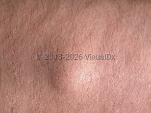 Clinical image of Angiolipoma - imageId=706754. Click to open in gallery.  caption: 'A close-up of a subcutaneous nodule.'