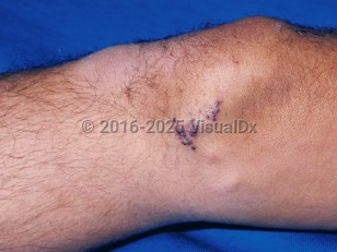 Clinical image of Lymphangioma circumscriptum - imageId=71303. Click to open in gallery.  caption: 'A cluster of discrete and confluent purple papules on the knee.'