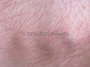 Clinical image of Mondor syndrome - imageId=729087. Click to open in gallery.  caption: 'A close-up of faint blue nodules in a linear array, and surrounding pink patches.'