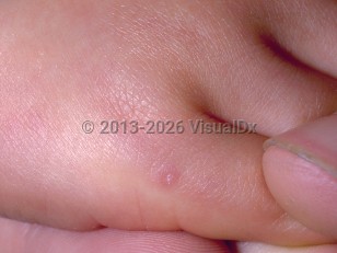 Clinical image of Infantile myofibromatosis - imageId=72924. Click to open in gallery.  caption: 'A tiny pink papule with scant overlying scale on the finger.'