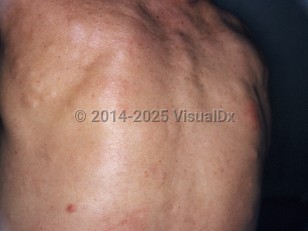 Clinical image of Familial cutaneous collagenoma syndrome - imageId=7302815. Click to open in gallery.  caption: 'Multiple skin-colored subcutaneous nodules on the back.'