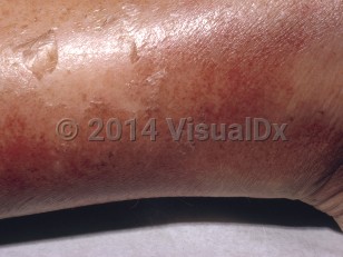 Clinical image of Alcoholic hepatitis - imageId=7359793. Click to open in gallery.  caption: 'Edema and superficial flaky desquamation of the leg.'