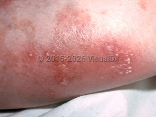 Clinical image of Pustular psoriasis of pregnancy - imageId=7372956. Click to open in gallery.  caption: 'A close-up of arcuate and annular erythematous plaques, some studded with pustules.'