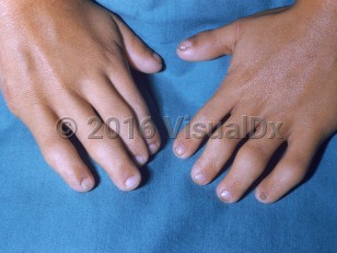 Clinical image of Ellis-van Creveld syndrome - imageId=7423781. Click to open in gallery.  caption: 'Broad fingers and micronychia.'