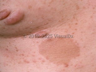 Clinical image of Neurofibromatosis - imageId=742400. Click to open in gallery.  caption: 'A close-up of pinkish and brownish papules and nodules (neurofibromas) and light brown patches (confetti and <span>café au lait </span> macules).'