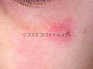 Clinical image of Spider angioma - imageId=749347. Click to open in gallery.  caption: 'A close-up of a tiny, bright red papule with numerous radiating telangiectasias and pink erythema on the cheek.'