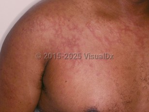 Clinical image of Parvovirus B19 infection - imageId=7602433. Click to open in gallery.  caption: 'Widespread deep pink, lacy plaques on the upper trunk and arm.<br/><br/>Image appears with permission from East Carolina University Division of Dermatology.'