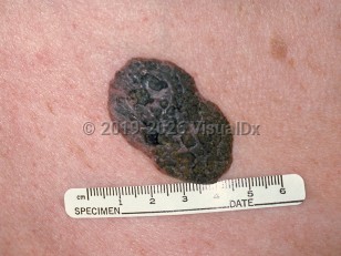 Clinical image of Seborrheic keratosis - imageId=76731. Click to open in gallery.  caption: 'An inflamed seborrheic keratosis showing a substantive pink and gray, stuck-on, verrucous plaque with keratotic plugs on the surface.'