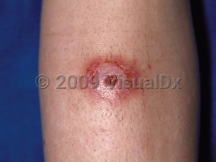 Clinical image of Spider bite - imageId=76956. Click to open in gallery.  caption: 'An eroded, erythematous nodule on the shin.'