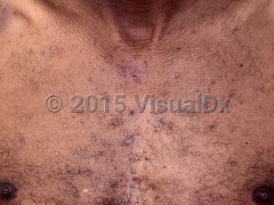 Clinical image of EGFR inhibitor-induced papulopustular eruption - imageId=7757239. Click to open in gallery.  caption: 'Scattered acneiform papules and tiny pustules on the chest.<br/><br/>Image appears with permission from East Carolina University Division of Dermatology.'