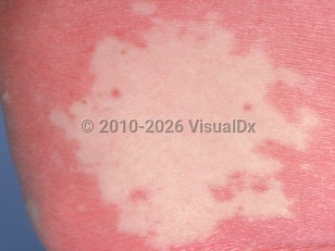 Clinical image of Pityriasis rubra pilaris - imageId=776192. Click to open in gallery.  caption: 'A close-up of an area of normal skin ("island of sparing") surrounded by a deep pink, scaly plaque.'