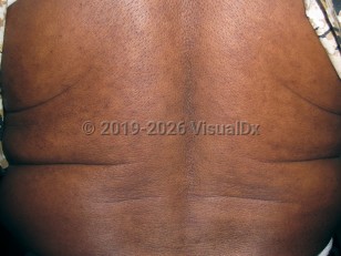 Progressive macular hypomelanosis