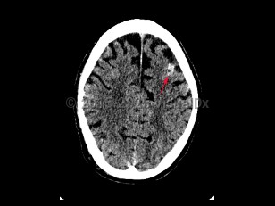 Imaging Studies image of Subarachnoid hemorrhage - imageId=7872963. Click to open in gallery.  caption: '<span>Axial CT image in a patient  with history of MVC, demonstrates a focal hyperdensity in the left  frontal lobe, consistent with subarachnoid hemorrhage.</span>'